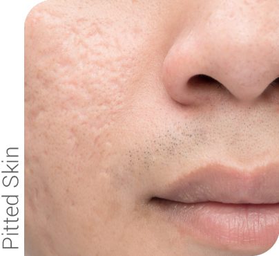 Microneedling and radio frequency reduced the depth and appearance of pitted skin caused by acne.