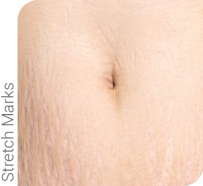 Microneedling and radio frequency can reduce stretch marks on various areas of your body.