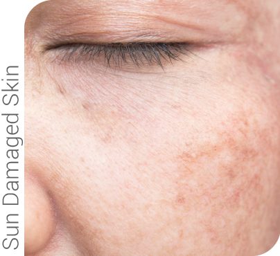 Microneedling and radio frequency can be used to treat sun damaged skin.