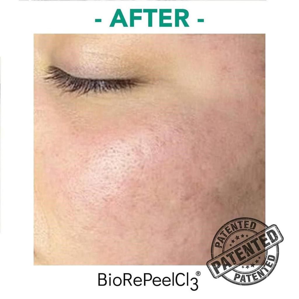 BRP CHEEK AFTER BRP CHEEK AFTER