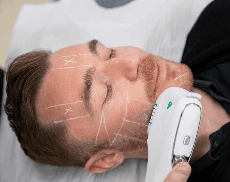 3D HIFU on a male client's face to firm and lift his skin.