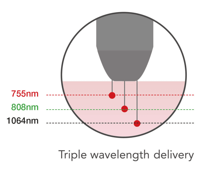 This laser hair removal device has triple wavelength delivery which penetrates the skin at 775nm, 808nm and 1064nm.