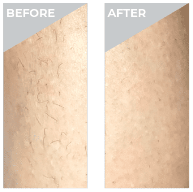 Laser hair removal before and after